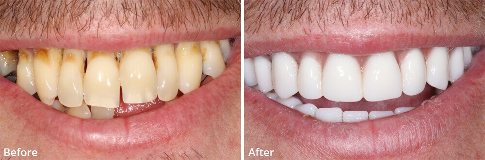 Upper Dentures Before And 
      After Pictures Vega TX 79092